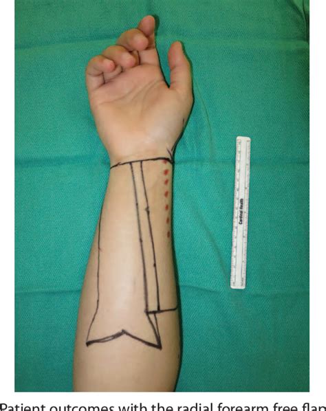 faloplastia|Phalloplasty: techniques and outcomes